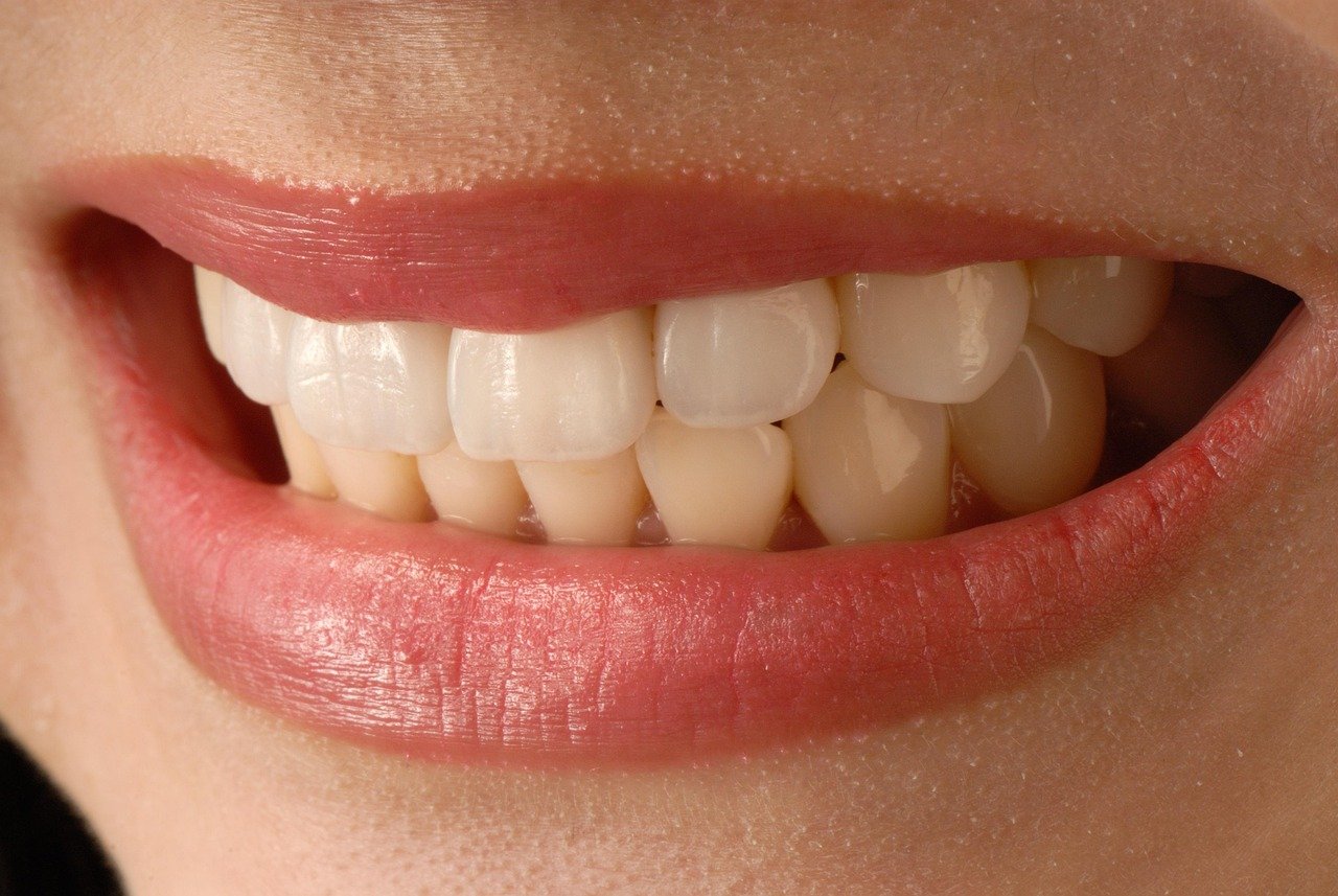 asian smile, anterior teeth, veneer, porcelain veneer, lip, beauty, veneer, veneer, veneer, veneer, veneer