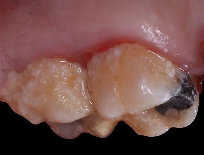 Caso Periodoncia 1