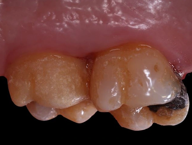 Caso Periodoncia 2