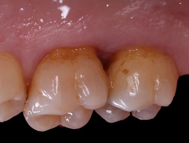 Caso Periodoncia 4