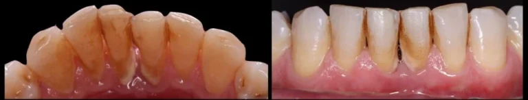 Periodoncia Caso 2 Antes 1024x195