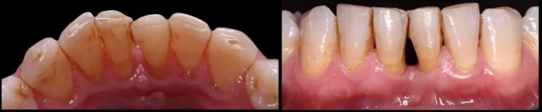 Periodoncia Caso 2 Despues 1024x212